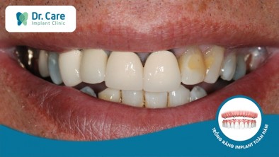 Mất răng toàn hàm sau khi làm cầu răng sứ nguyên nhân do đâu? 