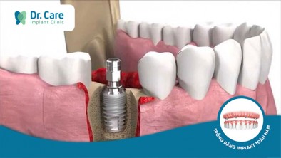 [Giải đáp] Chi phí trồng răng Implant tại TP. HCM có mắc không?