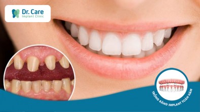 Bọc răng sứ là gì? Bọc răng sứ có làm răng thật yếu đi không?