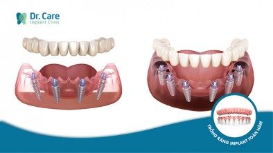 Dịch vụ trồng răng Implant toàn hàm tại nha khoa Dr Care có tốt không?