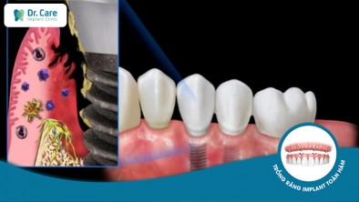 Trồng răng Implant có nguy hiểm không? Biến chứng có thể xảy ra?