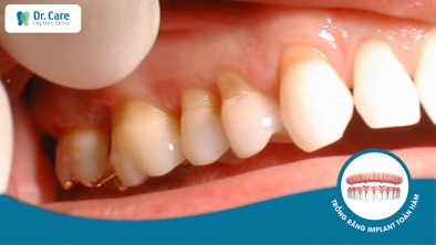 Mòn cổ chân răng gây hậu quả khó lường, đâu là cách điều trị?