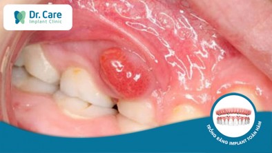 [CẨN TRỌNG] 6 hậu quả nguy hiểm do nhiễm khuẩn răng miệng