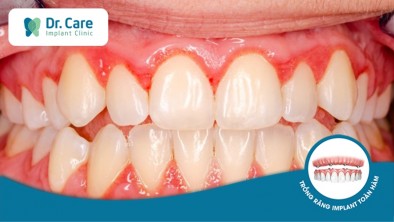 Bị viêm lợi sau khi bọc răng sứ điều trị bằng cách nào?