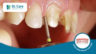 Ê buốt răng sau khi mài răng bọc sứ làm sao khắc phục?