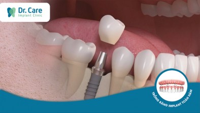 Chi phí trồng răng nhai bằng cấy ghép Implant bao nhiêu? 