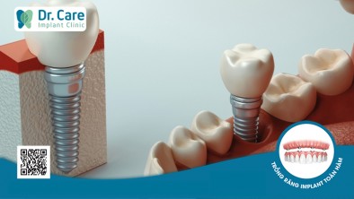 Khắc phục hậu quả trồng răng Implant thất bại