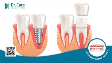 Bọc răng sứ hư có nên chuyển sang trồng Implant?