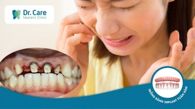 Răng mục nát sau khi bọc răng sứ - Nguyên nhân và khắc phục