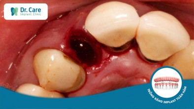 Viêm huyệt ổ răng là gì, đâu là cách xử lý?