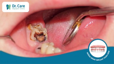 Sâu răng nặng nguy hiểm như thế nào, đâu là cách điều trị?