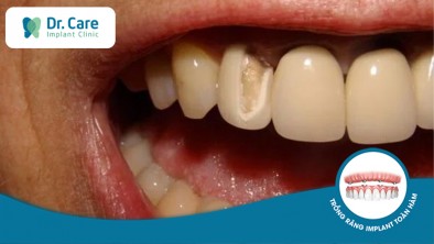 Bọc răng sứ bị viêm tủy nguyên nhân do đâu? Điều trị ra sao?