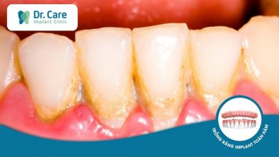 Nguyên nhân gây mảng bám chân răng và cách loại bỏ?