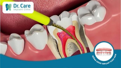 ​​​​​​​Viêm tủy răng số 7 gây nên những hậu quả gì?