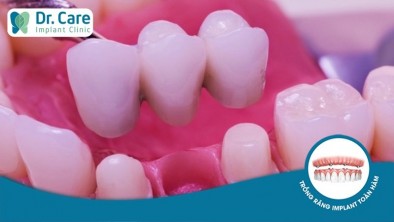Đau răng sau khi làm cầu răng sứ có nguy hiểm không?