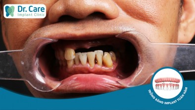 Mất 5 răng liên tiếp trồng răng lại bằng cách nào?