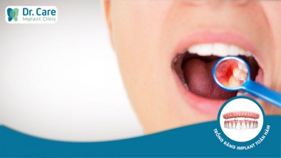  Nguyên nhân và cách giảm đau răng, sưng lợi hiệu quả 