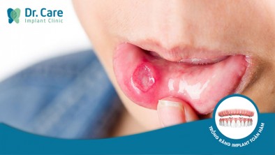 Nhiệt miệng là gì? Nguyên nhân và cách phòng ngừa hiệu quả