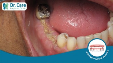 Vì sao vết thương lâu lành khi trồng răng Implant?