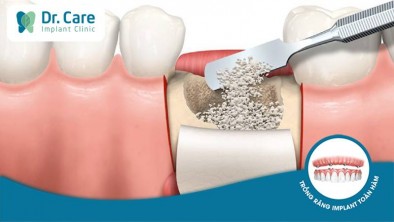 Giải đáp: Tại sao cần phải ghép xương trước khi trồng răng implant?