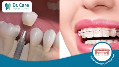 Mất răng nên niềng răng hay trồng răng implant? 