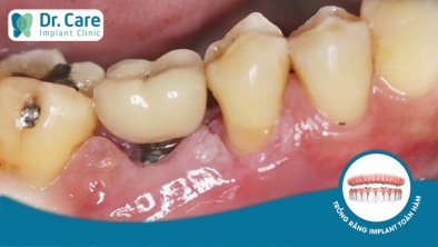Tác hại của thuốc lá đối với trồng răng Implant?