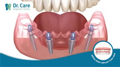 Vì sao trồng răng Implant toàn hàm All on 4 lại tiết kiệm được chi phí?