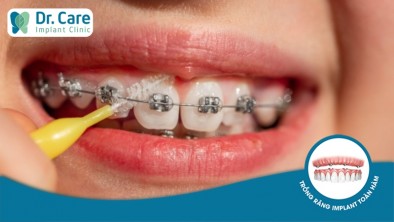 Nên niềng răng trước hay trồng răng Implant trước?