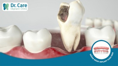 [Giải đáp] Có nên nhổ răng hàm bị sâu không?