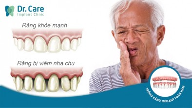 Nguy cơ mất răng do phát hiện viêm nha chu muộn