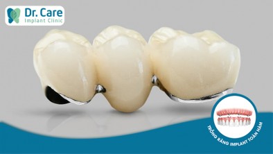 3 loại răng sứ kim loại chất lượng tốt trên thị trường