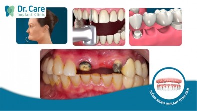 Vì sao làm cầu răng sứ khiến 2 răng bên cạnh bị yếu đi?