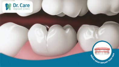 Nứt dọc thân răng là gì? Răng nứt dọc có thể bọc răng sứ không?