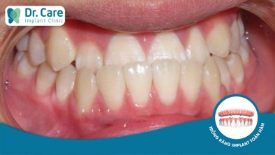 Bị móm răng nên niềng răng bằng mắc cài sứ hay trồng răng Implant? 