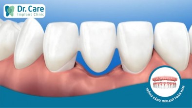 Răng sứ bị lung lay: Nguyên nhân và cách khắc phục?