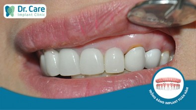 Cách xử lý khi răng sứ bị hở chân răng như thế nào?