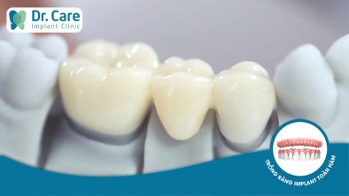 [Giải đáp] Nên sử dụng răng sứ hay răng nhựa Composite?