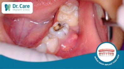 [Giải đáp]: Cách điều trị áp xe răng hiệu quả là gì?