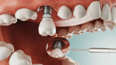 Những yếu tố nào ảnh hưởng đến chi phí trồng Implant răng?