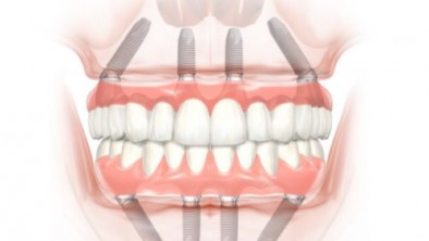 Khi trồng nhiều răng Implant, có giảm giá hay gói dịch vụ đặc biệt nào không?
