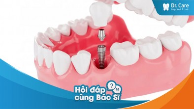 Yếu tố nào khác có thể ảnh hưởng đến giá trồng răng Implant, ngoài số lượng răng mất?
