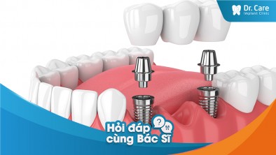 Răng sứ trên Implant có được tính trong chi phí trồng răng không?