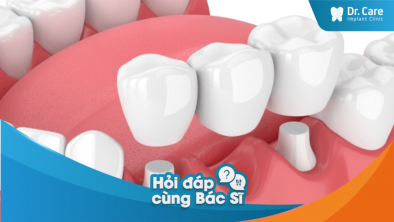 Bị tiêu xương hàm sau 1 khoảng thời gian dùng cầu răng sứ làm sao khắc phục?