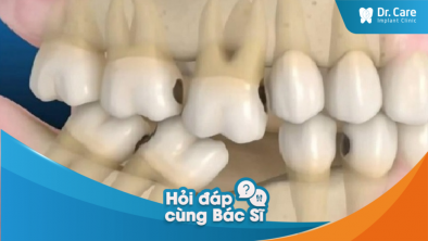 Các dạng tiêu xương răng thường gặp sau khi nhổ răng là gì?