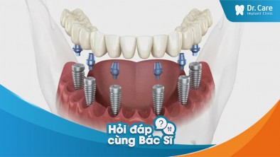 Trồng răng Implant toàn hàm có ưu điểm gì nổi bật so với hàm tháo lắp không?
