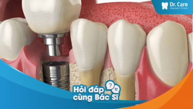 Thay thế răng thật sau khi đã mất răng có ngăn ngừa tình trạng tiêu xương không?