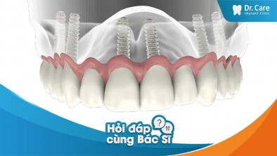 Quá trình trồng răng Implant toàn hàm diễn ra như thế nào?
