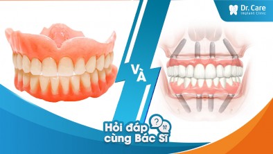 Phương pháp trồng răng Implant toàn hàm và hàm giả tháo lắp có khác gì nhau không?