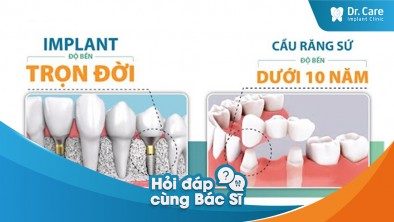 Sử dụng cầu răng sứ thời gian dài trồng răng Implant toàn hàm để thay thế được không?