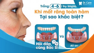 Trồng răng Implant toàn hàm All on 4 có khác gì so với All on 6 không?
